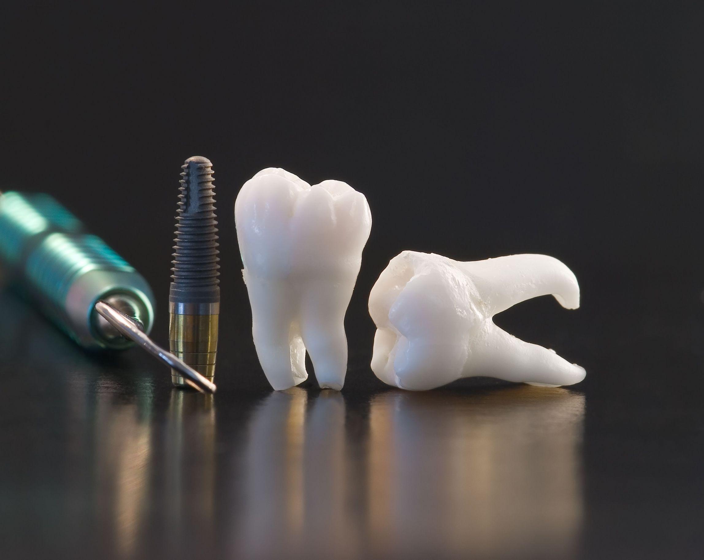 A tooth and dental implant are shown - Dentist